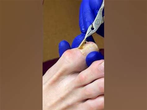 🤯 ШОК-контент! Сняли ноготь полностью без анестезии! #подология # ...