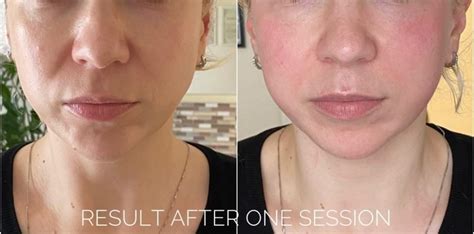 face plumping  anti aging treatment piethis