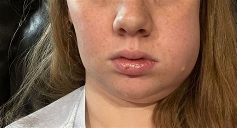 swollen face  wisdom tooth removal babycenter