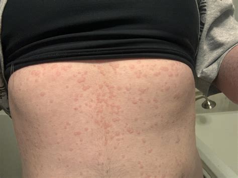 so tired of this. full body hives nearly daily. : r/urticaria