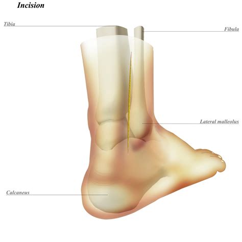 Lateral Malleolus Definition In Anatomy at Marjorie Lachance blog