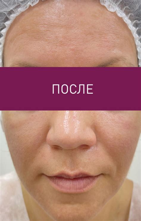 PRX Therapy - PRX-T33