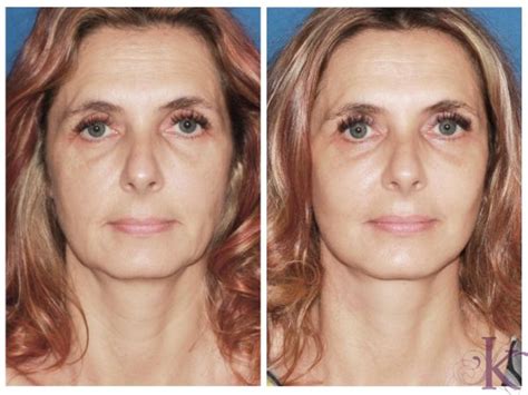 quicklift mini facelift  george tarenorerer blog