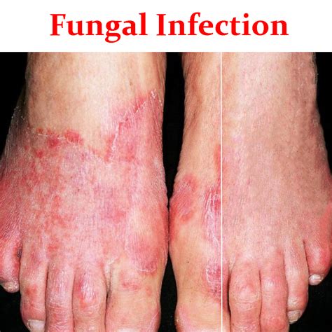 fungal infection product box sharma pharmacy
