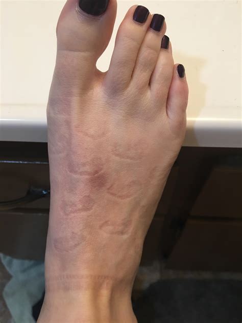 I tied my shoes too tight and now have tiny croissants imprinted on my