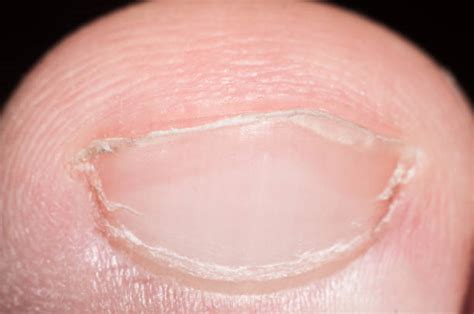 310+ Curved Toenails Stock Photos, Pictures & Royalty-Free Images - iStock