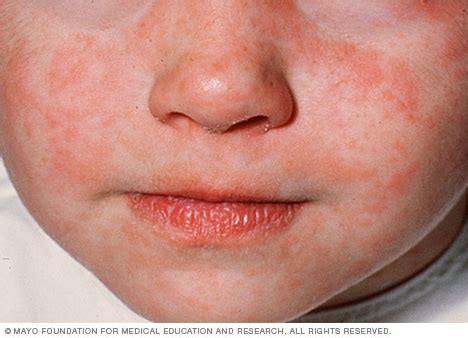 Measles - Symptoms and causes - Mayo Clinic