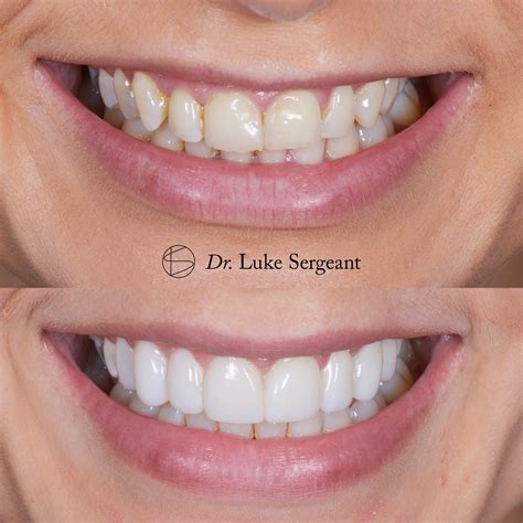 Composite Bonding — Raby Road Dental Cosmetic & General Dentist, Neston