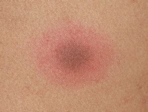 Lesiones diana y diana diana - Dermatly.com - El sitio de tu piel