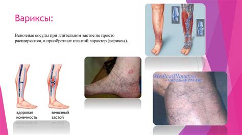 Венозная гиперемия - презентация онлайн