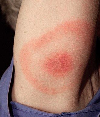 erythema migrans - Wiktionary, the free dictionary