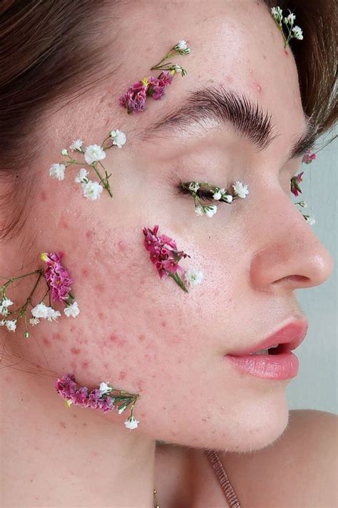 Can retinol be used for acne? Here's what dermatologists say | Vogue India