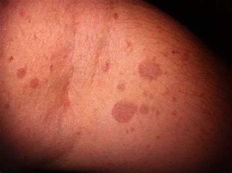red spots   skin     treatment vrogueco