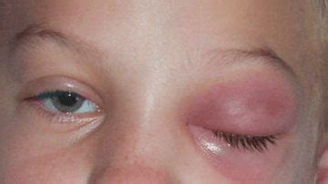 Pediatric Ophthalmology : Congenital Nasolacrimal Duct Obstruction ...