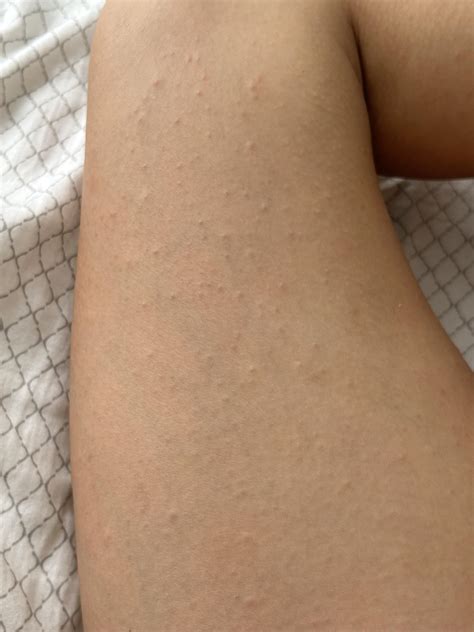 Is this KP? I keep reading that KP isn’t itchy, but this is super itchy