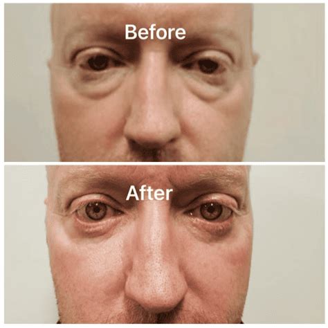 Before And After | Adam J Cohen, MD In Chicago & Glenview