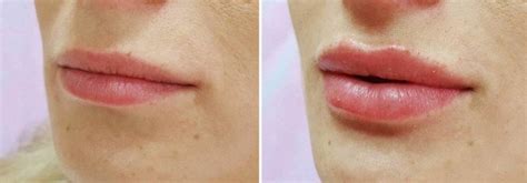 Филлер Ювидерм – мощный увлажнитель (коллекция Juvederm)