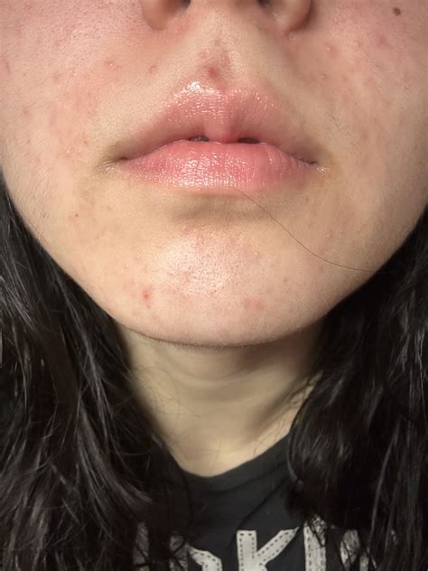 recently took antibiotics and broke out! pls help me – Acne – Acne.org