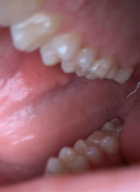 Small white bump : r/DentalHygiene