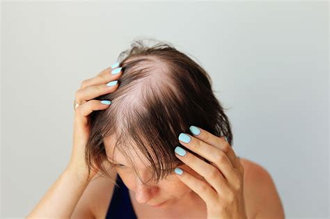 Explorerance.com | Alopecia areata – Symptoms, causes, and management ...