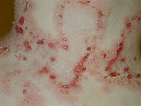 epidermolysis bullosa pictures - pictures, photos