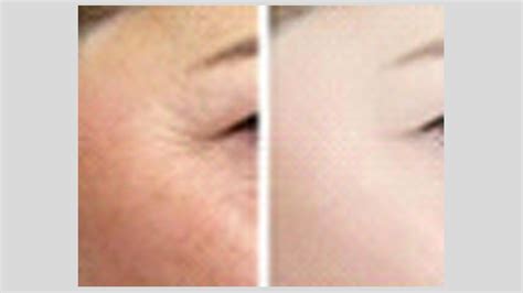 Skin Solution For Saggay Skin