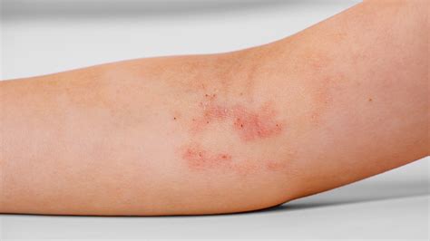 difference  eczema  psoriasis nhs  catherine dorsey blog