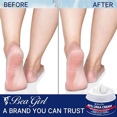 Urea Cream 40% for Intensive Foot Repair & Callus Remover - Softens and