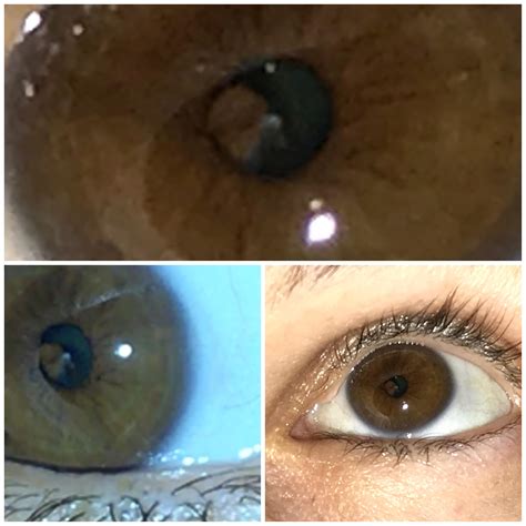 Part of my iris is in my pupil. : r/optometry