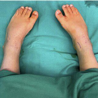 Preoperative clinical picture before surgery. | Download Scientific Diagram