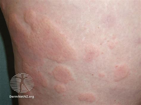 Allergy Rashes: Images, Symptoms, Treatment