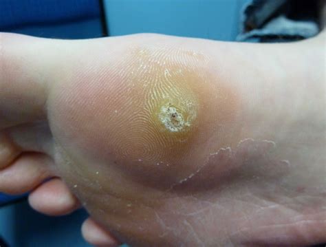 Plantar Wart For 15 Years at Mario Anderson blog