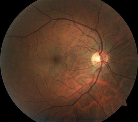 Optical Coherence Tomography