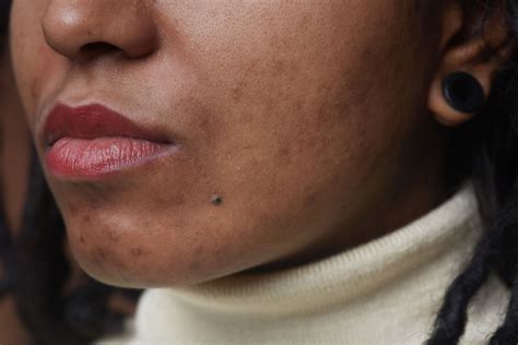 How to Treat Acne and Post-Acne Marks on Dark Skin, According to a
