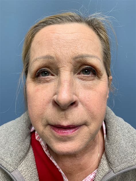 Patient B - Post-Operative Facial Fat Grafting *This patient wanted