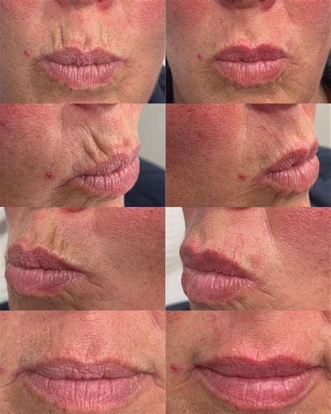 smokers lines filler  comprehensive guide