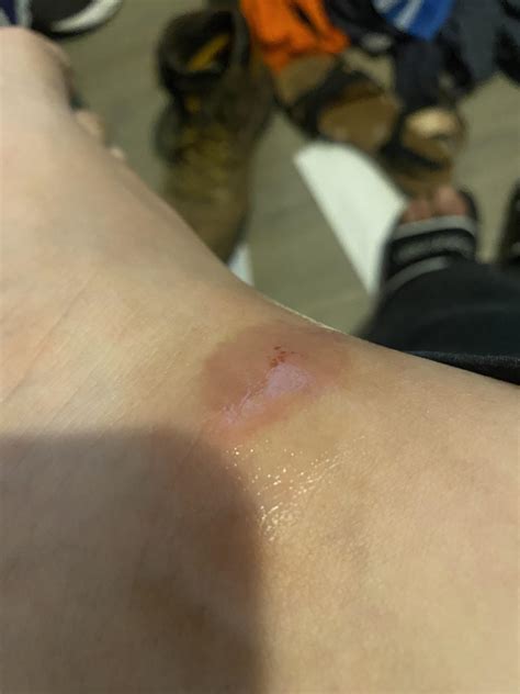 I don’t know what bit me but it’s really itchy and it’s purple : r/bugbites