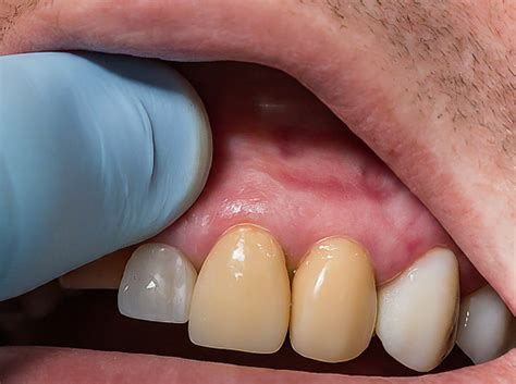 Unveiling the Secrets of Zirconia Crowns: A Cost Guide for zirconia ...