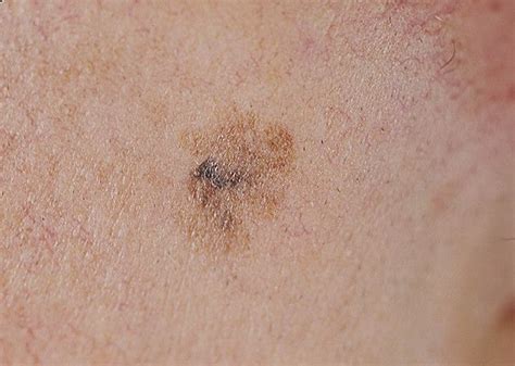Лентиго меланома фото – 29 шт. / fotodiagnoz.com
