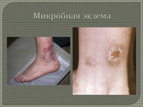 Экзема (eczema; греч. ekzema высыпание на коже) - презентация онлайн