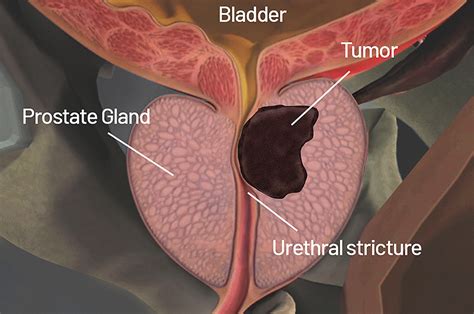 Health Topic - Prostate Cancer