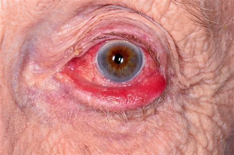 drooping  eyelid stock image  science photo library