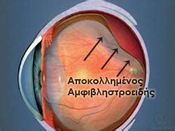 Αποκόλληση Αμφιβληστροειδούς - Athens Eye Hospital