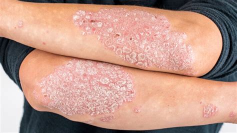 Qu’est-ce que le psoriasis ? Symptômes, causes et traitement ...