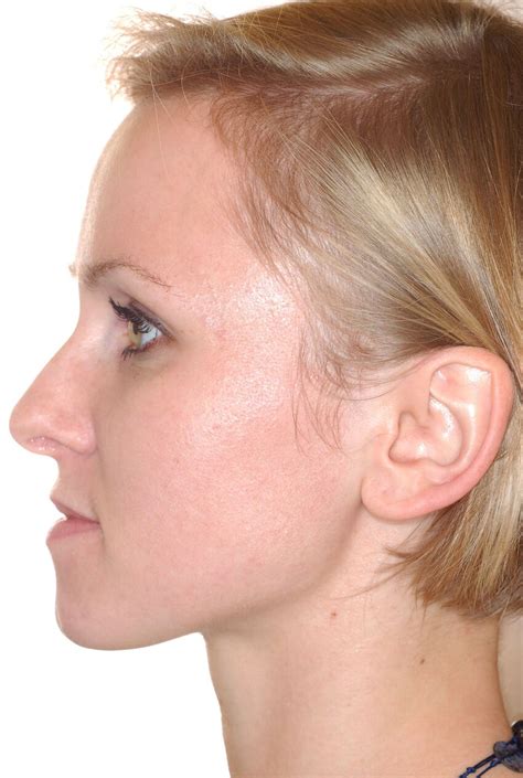 lateral view  treatment left side  scientific diagram