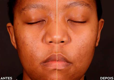Nivea Luminous 630 Melasma Antes E Depois - Luminous 630 Antimarcas: linha completa | Nivea
