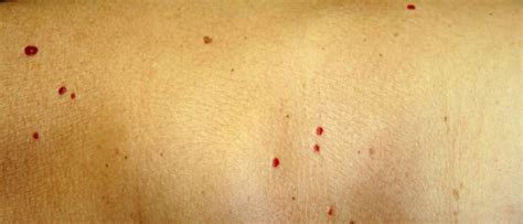 Ангиома – что это за болезнь, 💉 лечение, симптомы и 🔬 диагностика на ...