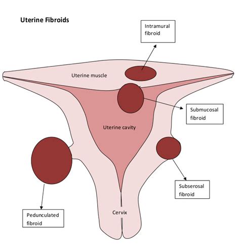 Uterine Fibroid Uterus Size Chart