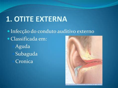 Otite Externa Em Bebe - PPT - OTITES 1. Otite Externa PowerPoint Presentation - ID:230993