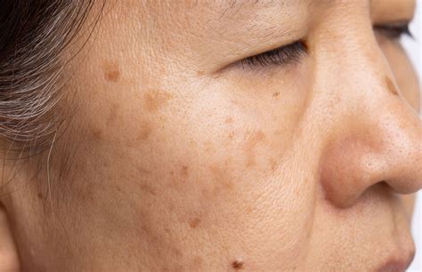 Melasma/Pigmentation — Dr Shreya Andric | Northern Sydney Dermatologist